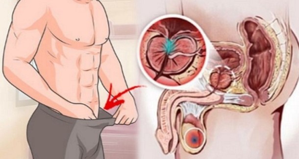 Cause of Prostate Enlargment