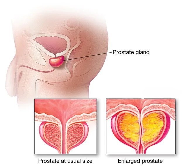 Prostate Enlargment